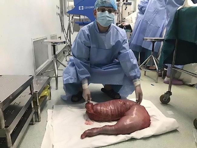 Soffre di costipazione da quando è nato: gli rimuovono colon con 13 kg di feci FOTO