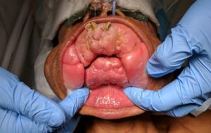 Iperplasia gengivale, bocca gigantesca: operazione storica salva un uomo