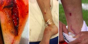Mandzukic, ferita choc (FOTO): 10 punti di sutura per fallo di Vecino in Inter-Juventus