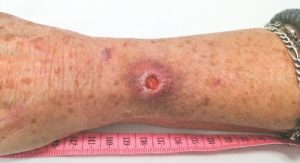 Ulcera carnivora (di Buruli): in Australia siamo all'epidemia. Un batterio divora la pelle
