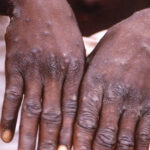 Vaiolo delle scimmie, 11 casi a Firenze: come avviene il contagio e i sintomi