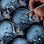 legame tra alzheimer e colesterolo alto