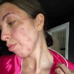 Cimici, come combatterle e sterminarle, i consigli di una newyorkese