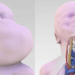 tumore gola neonato salvato