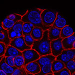 tumore pancreas sopravvivenza