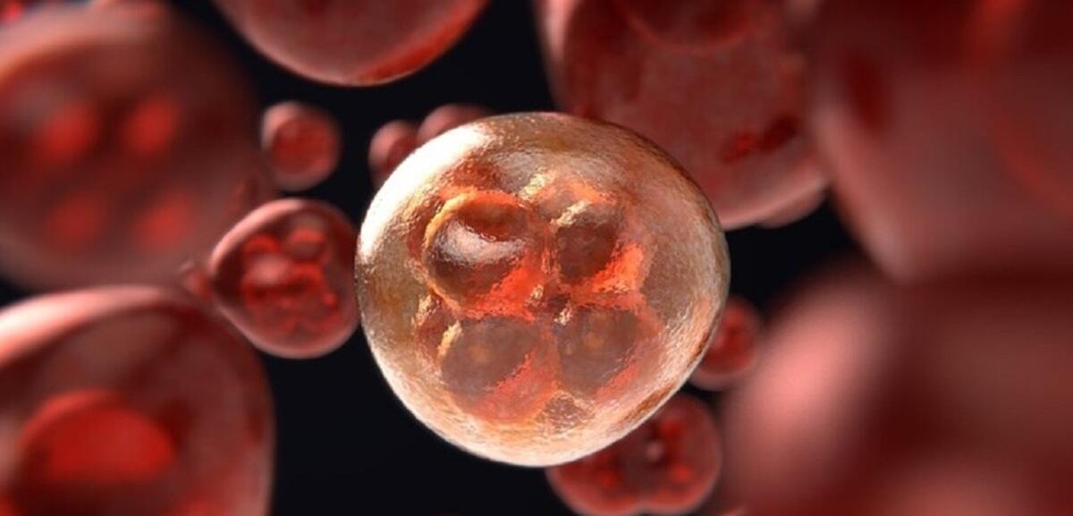 tumore al colon retto