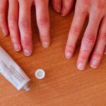 cause dei geloni e come curarli