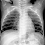 radiografia virus hmpv