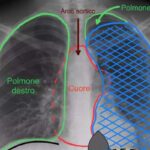 intervento polmone torino