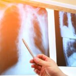 Cause cancro ai polmoni