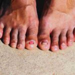 piedi freddi e unghie spesse: i problemi