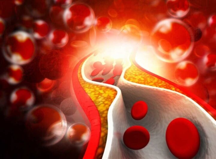 arterie con colesterolo