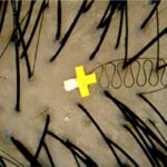 microsensore nei follicoli piliferi