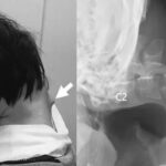 Un ragazzo con la sindrome della testa cadente