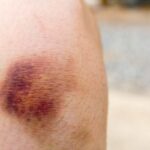 Lividi spontanei, non sforzarti di capire dove hai sbattuto