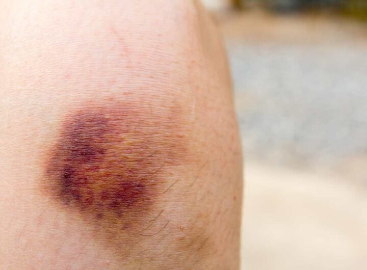 Lividi spontanei, non sforzarti di capire dove hai sbattuto