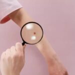 melanoma sotto la lente