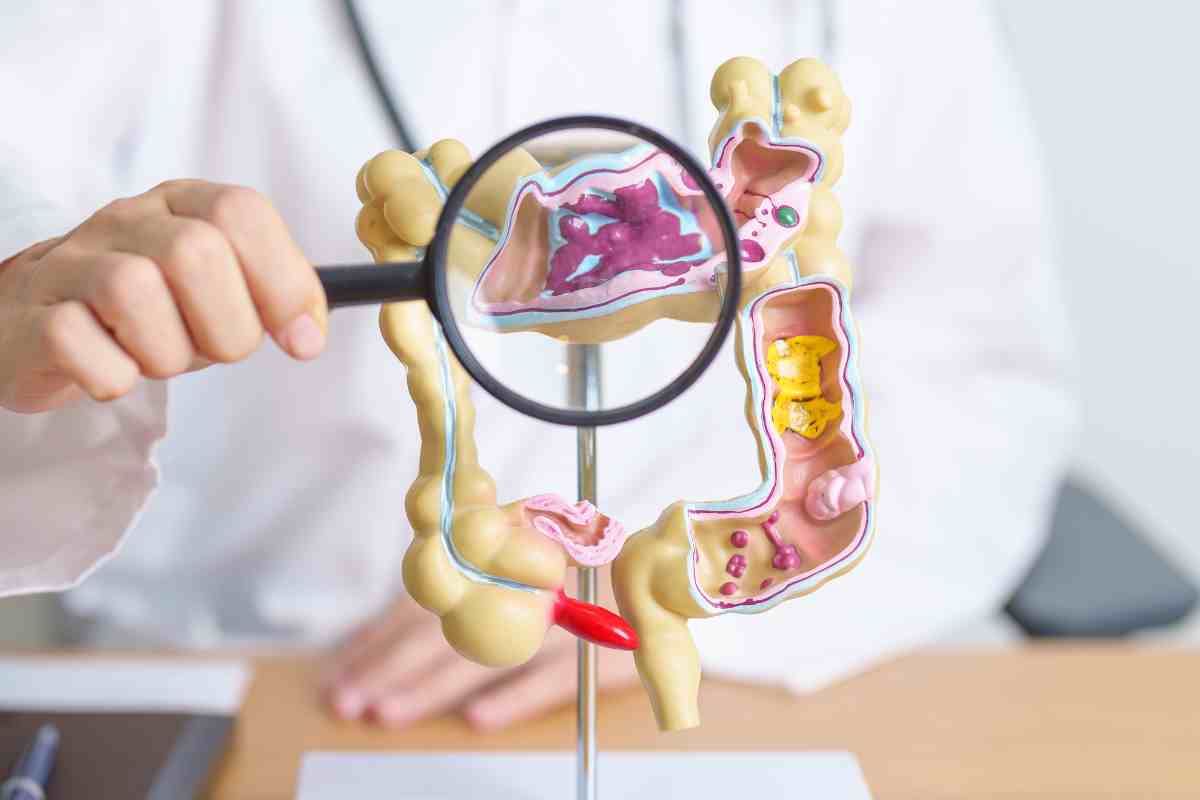 Tumori al colon e al retto, i medici avvertono: è la nuova piaga che colpisce gli italiani ma ci si può difendere così