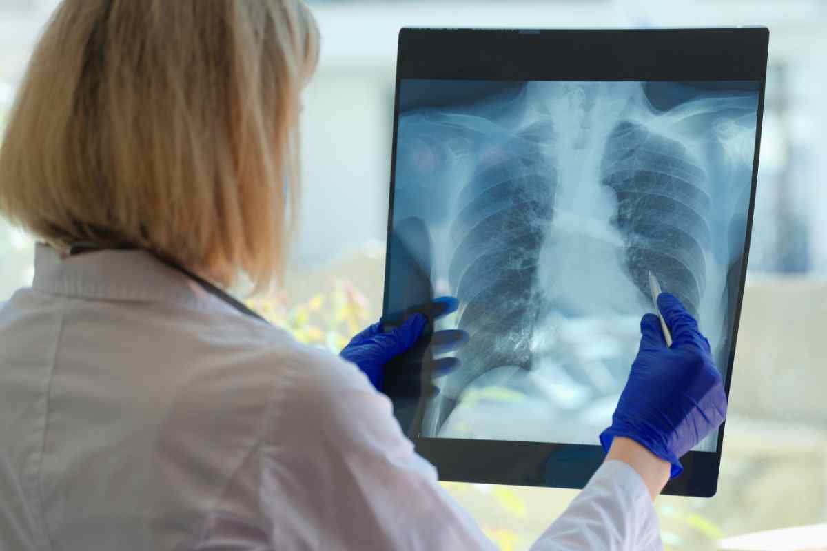 Tumore al polmone: il sintomo insospettabile che può salvarti la vita