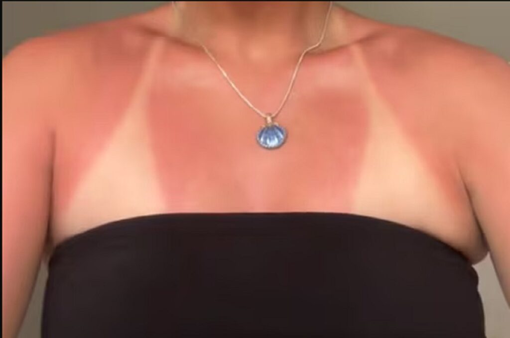 Una ragazza ustionata dal Sunburn Challenge