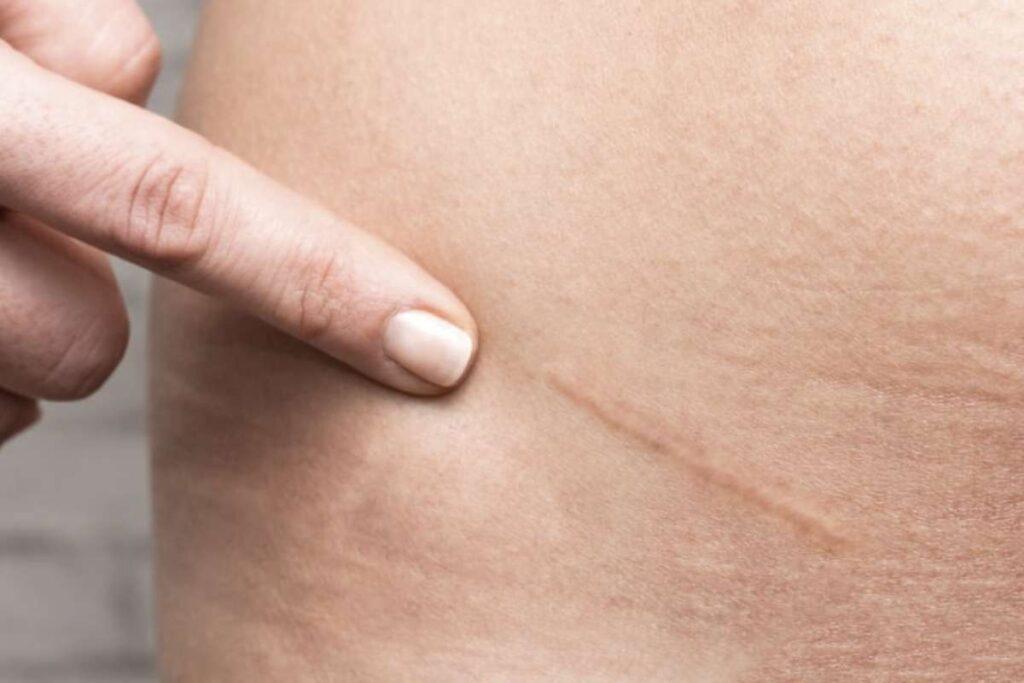 Carcinoma spinocellulare: definizione e caratteristiche cliniche