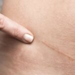 Carcinoma spinocellulare: definizione e caratteristiche cliniche