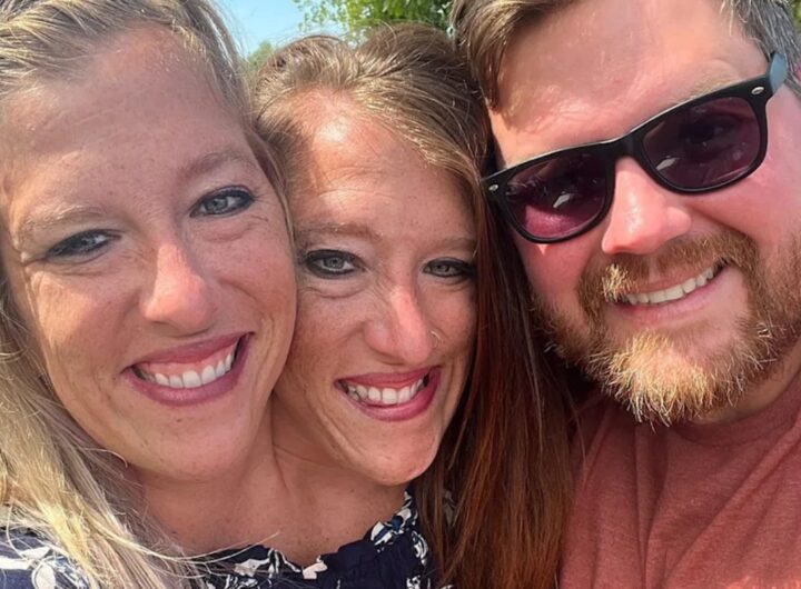 gemelle siamesi hensel