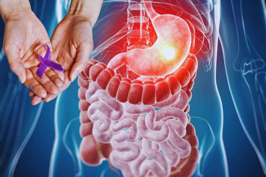 i primi sintomi del cancro allo stomaco
