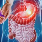 i primi sintomi del cancro allo stomaco