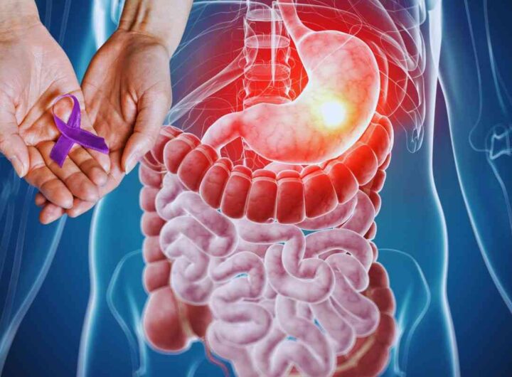 i primi sintomi del cancro allo stomaco