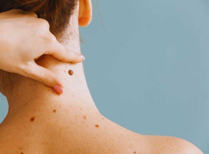 nei maligni: come riconoscerli