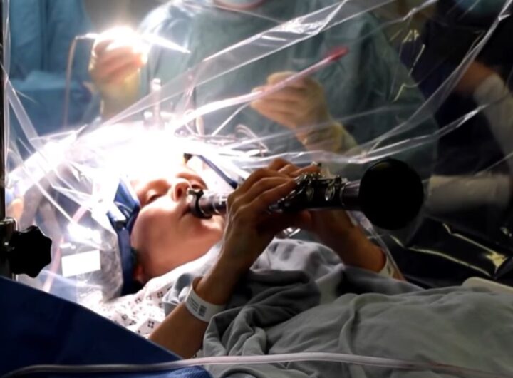 operazione al cervello