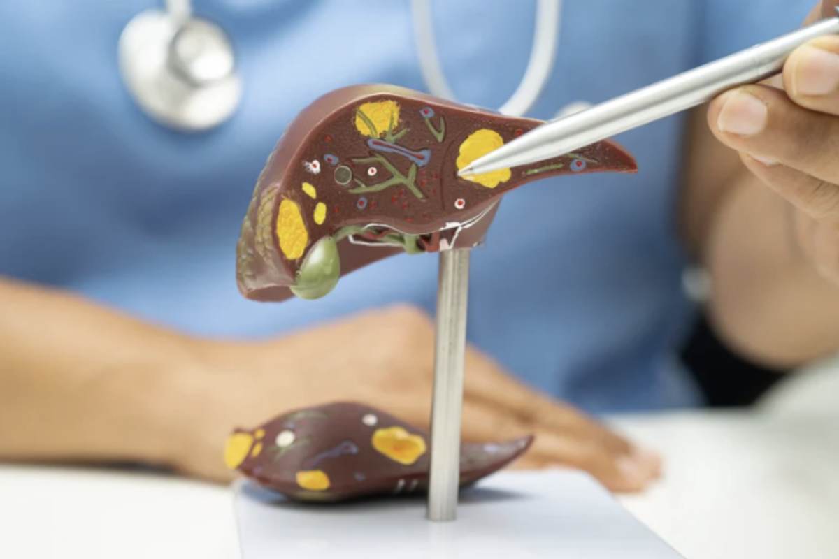 Parallelamente alla MASLD, un’altra patologia epatica di rilievo mondiale è rappresentata dall’epatite C (HCV), una malattia virale