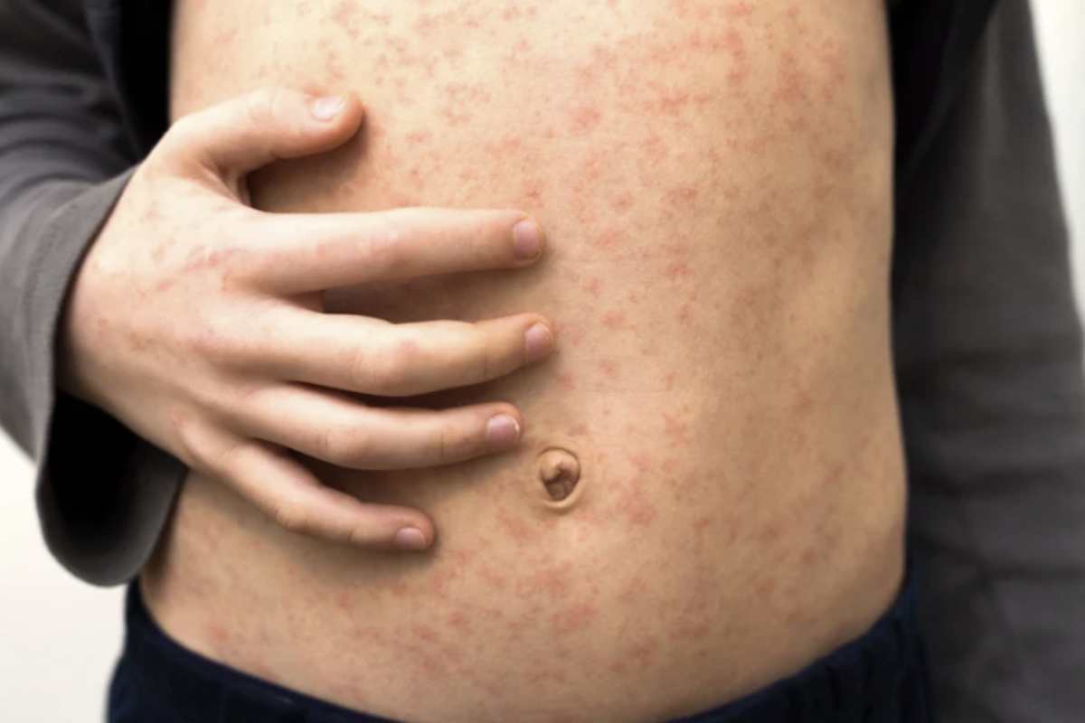 Il morbillo è una malattia infettiva esantematica acuta causata dal virus del genere Morbillivirus, caratterizzata da febbre alta,