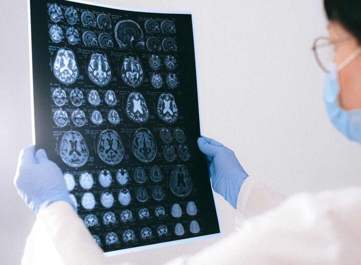 Alzheimer diagnosi precoce