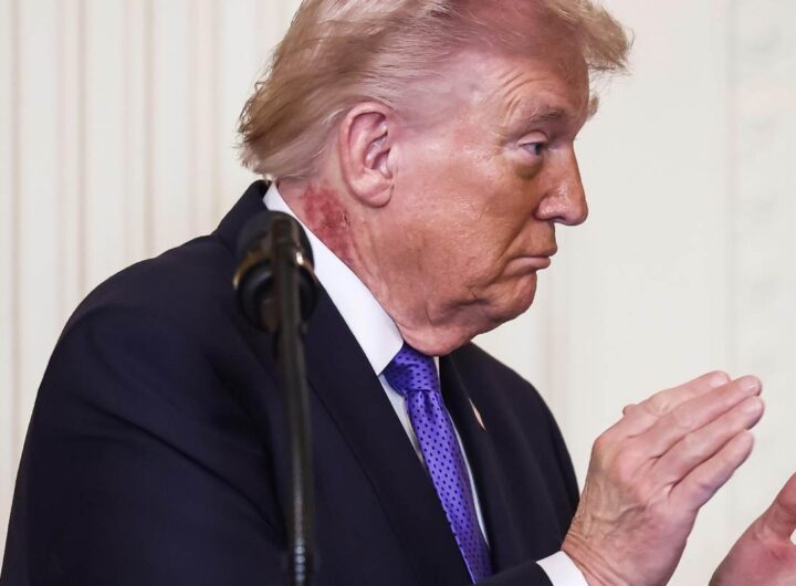 Sul collo di Trump spunta una macchia rossa