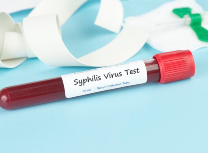 test sifilide