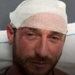 Angelo Ratti con la testa fasciata