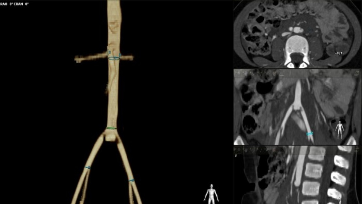 operazione aorta
