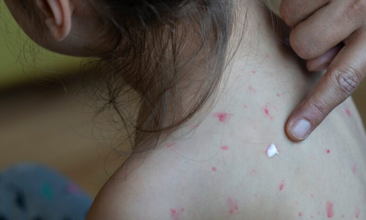morbillo