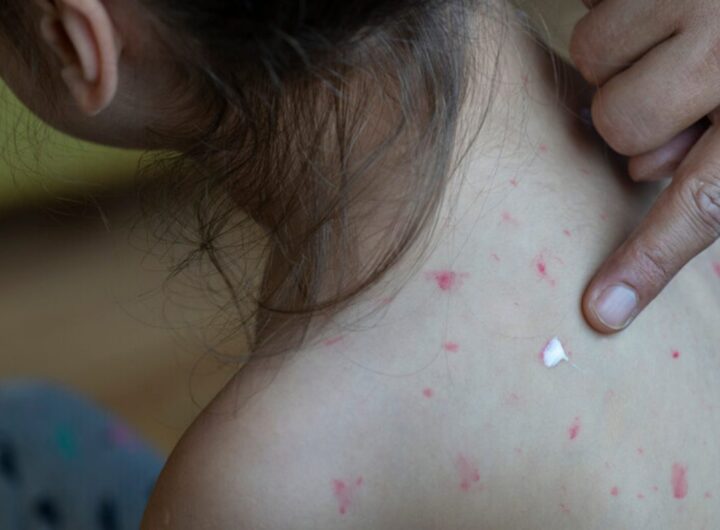 morbillo