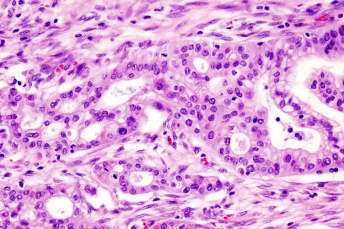 Tumore al pancreas, dalla Ue prima autorizzazione al daraxonrasib. Ora tocca agli Stati per prezzo e rimborsi