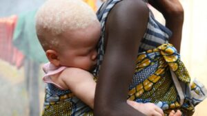 Albini in Malawi cacciati come selvaggina: le loro ossa vendute per riti magici