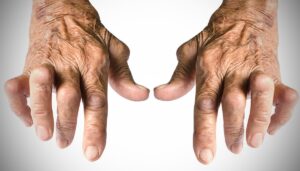 Artrite reumatoide, scoperto nuovo "pulsante" che la spegne