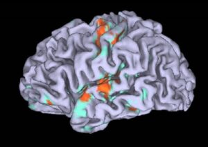 Cervello, scoperto il gene che innesca la depressione