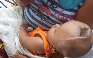 Simon Sama, il neonato con una malformazione al cranio abbandonato dai genitori