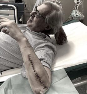Vittorio Sgarbi, grossa cicatrice sul braccio: la foto fa preoccupare i fan