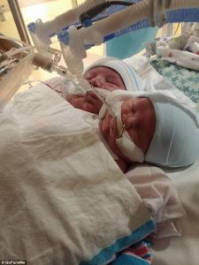 Cincinnati, nati gemelli siamesi inoperabili. I genitori non hanno voluto abortire01