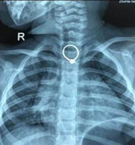 L'anello nell'esofago della bimba di due anni