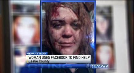 Aggredita dal marito : Susann Stacy pubblica la foto su Facebook e viene salvata